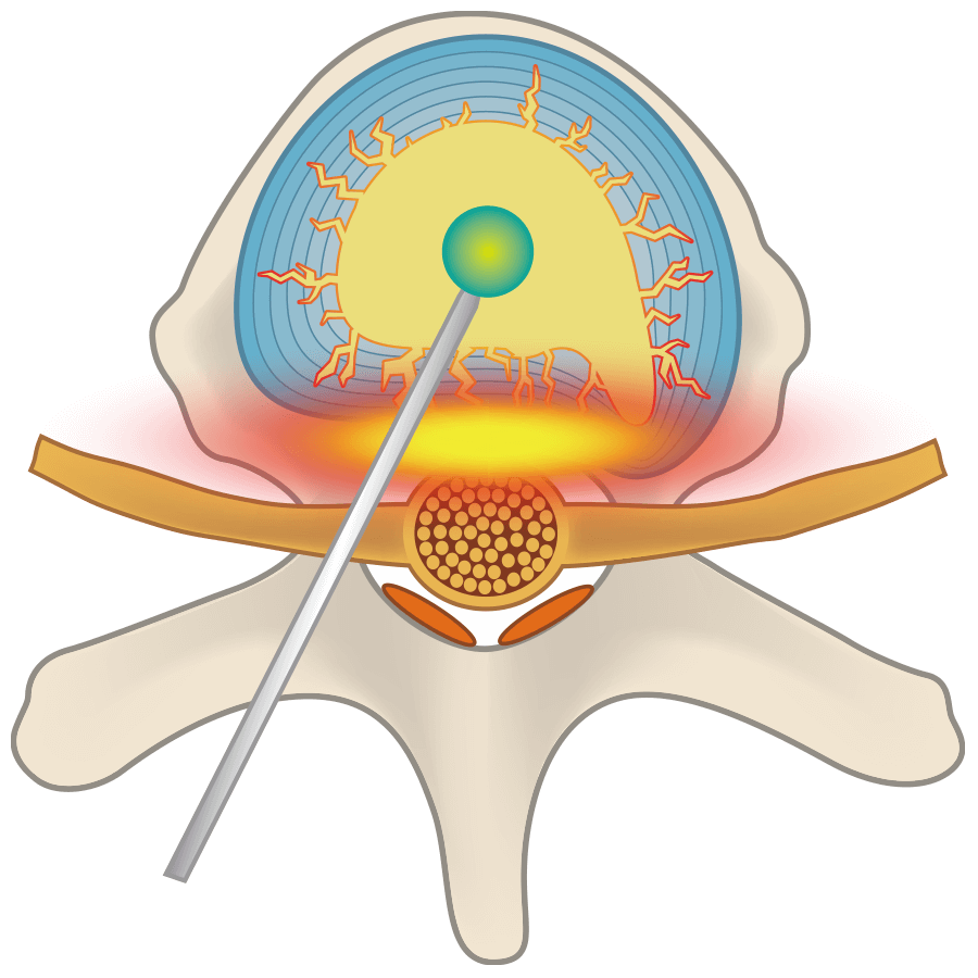 A needle is inserted into the cracked intervertebral disc, and medicine is injected.
