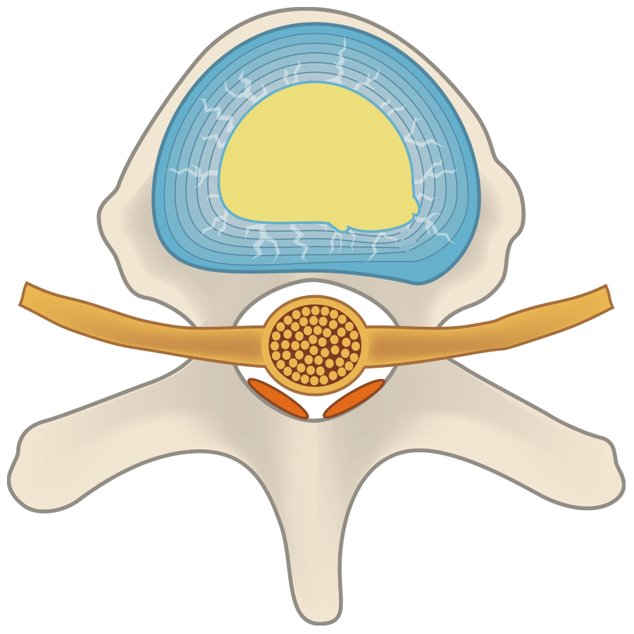 The intervertebral disc is repaired and regenerated.