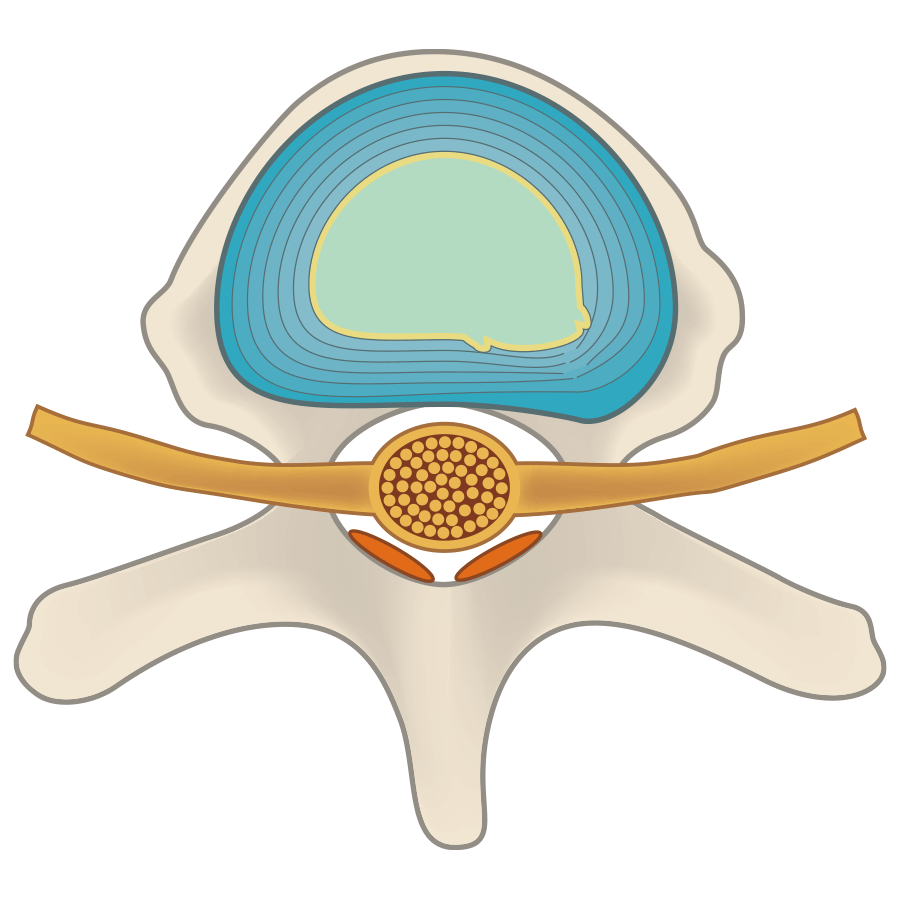The protruding intervertebral disc is restored by decompression, and material that will function as a buffer (cushion) remains in the intervertebral disc as an implant after treatment.