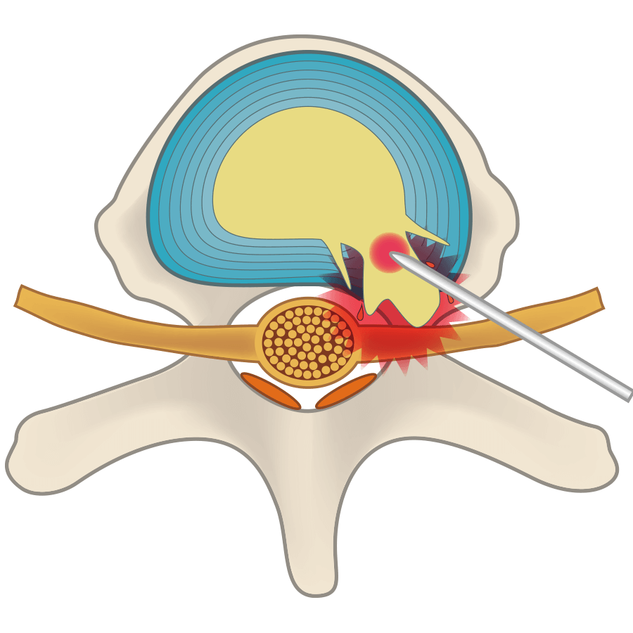 A hollow is made in the nucleus pulposus inside the intervertebral disc by cauterizing it with a laser.