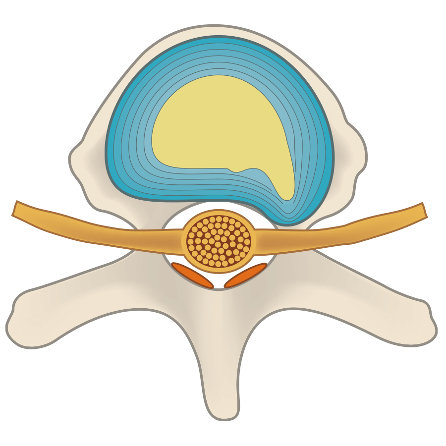 The protruding intervertebral disc is caused to shrink, and pressure on the nerves is reduced.