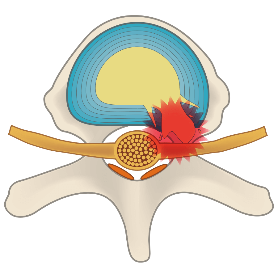 Disc herniation causing inflammation of the compressed nerve.