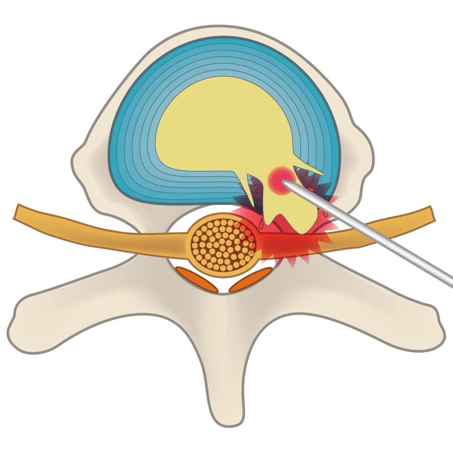 A hole is made by cauterizing the nucleus pulposus inside the intervertebral disc with a laser, and the disc is caused to shrink.