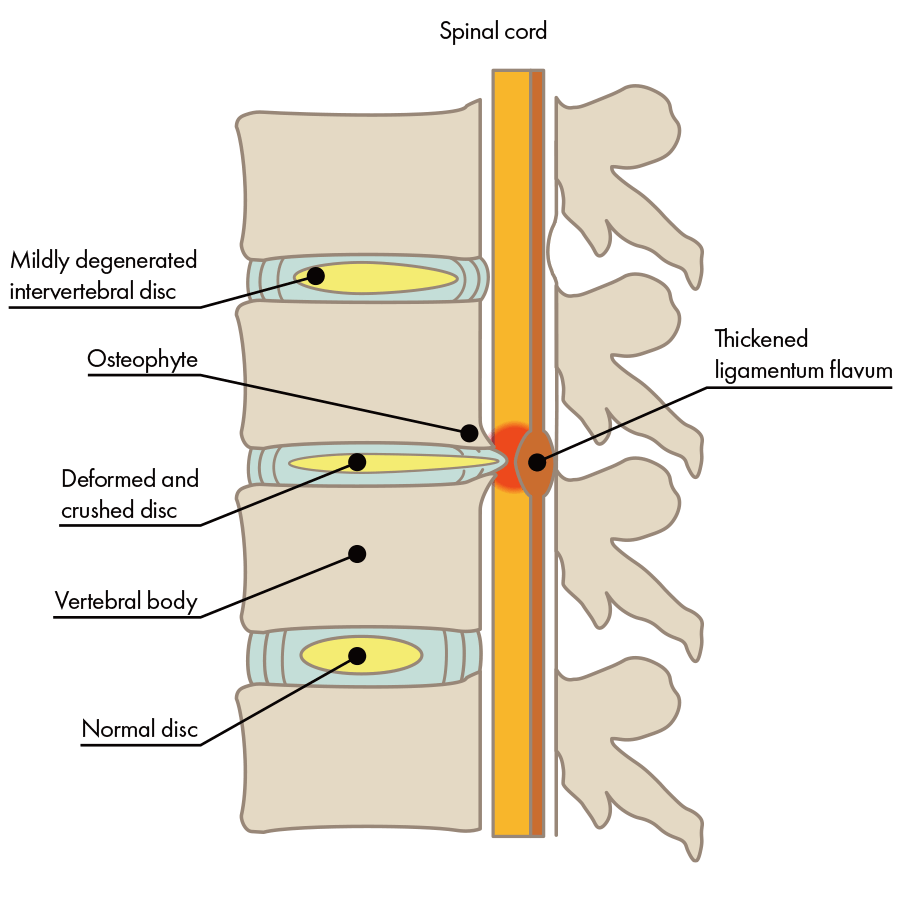 The intervertebral disc has collapsed, the bone is deformed, and pressure has been placed on the nerve.
