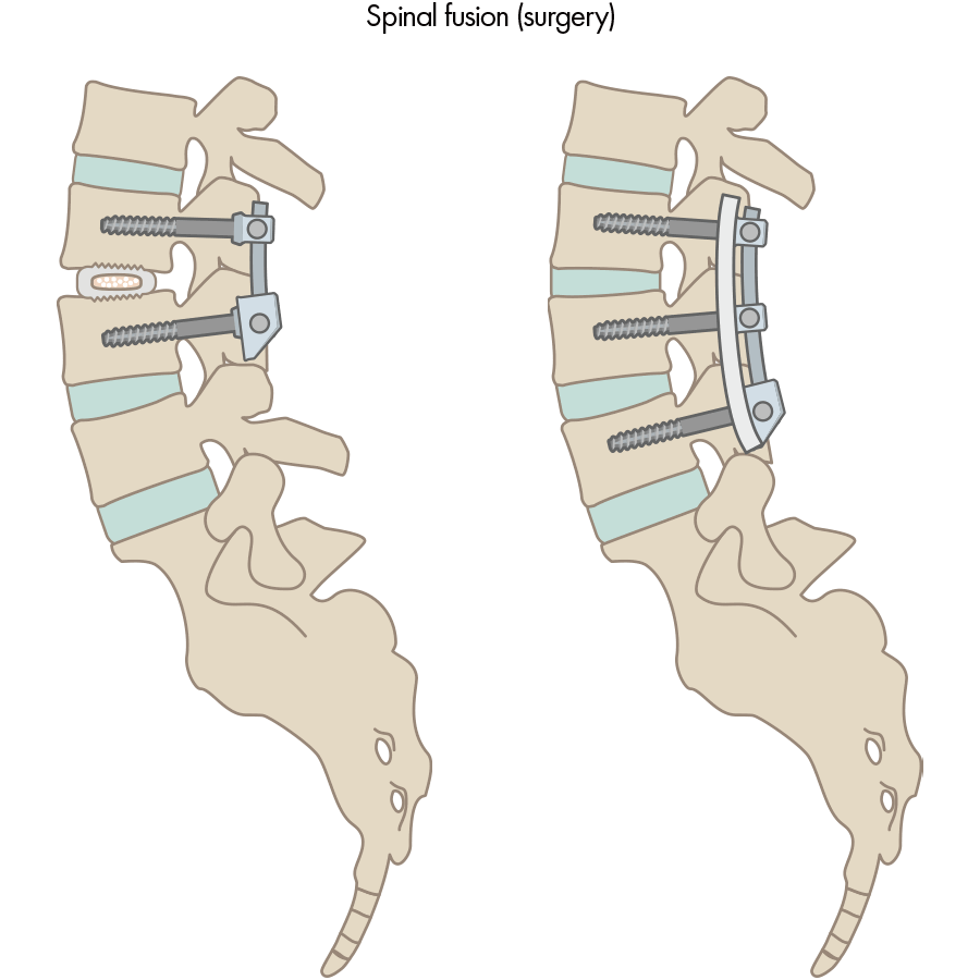 Alternative treatment spinal fusion