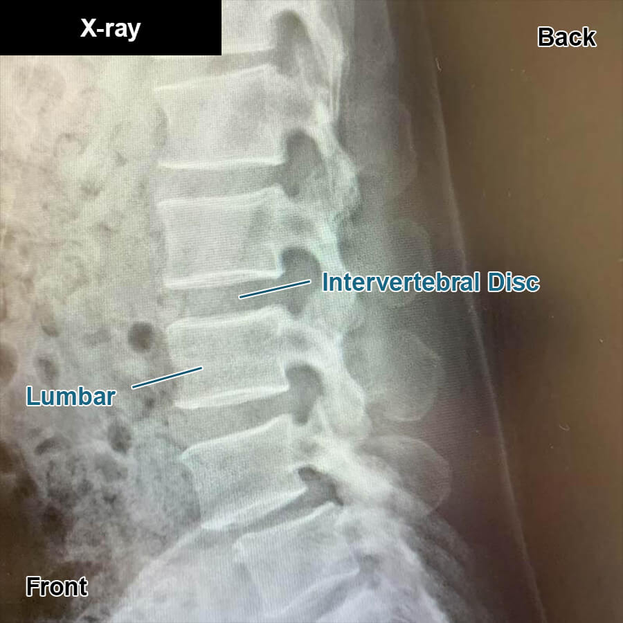 How is spondylolisthesis diagnosed?：x-ray examination