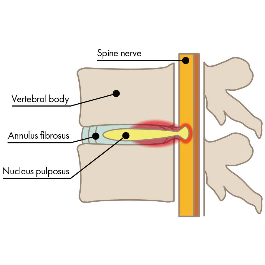 Non-Contained Herniation (Disc Extrusion)