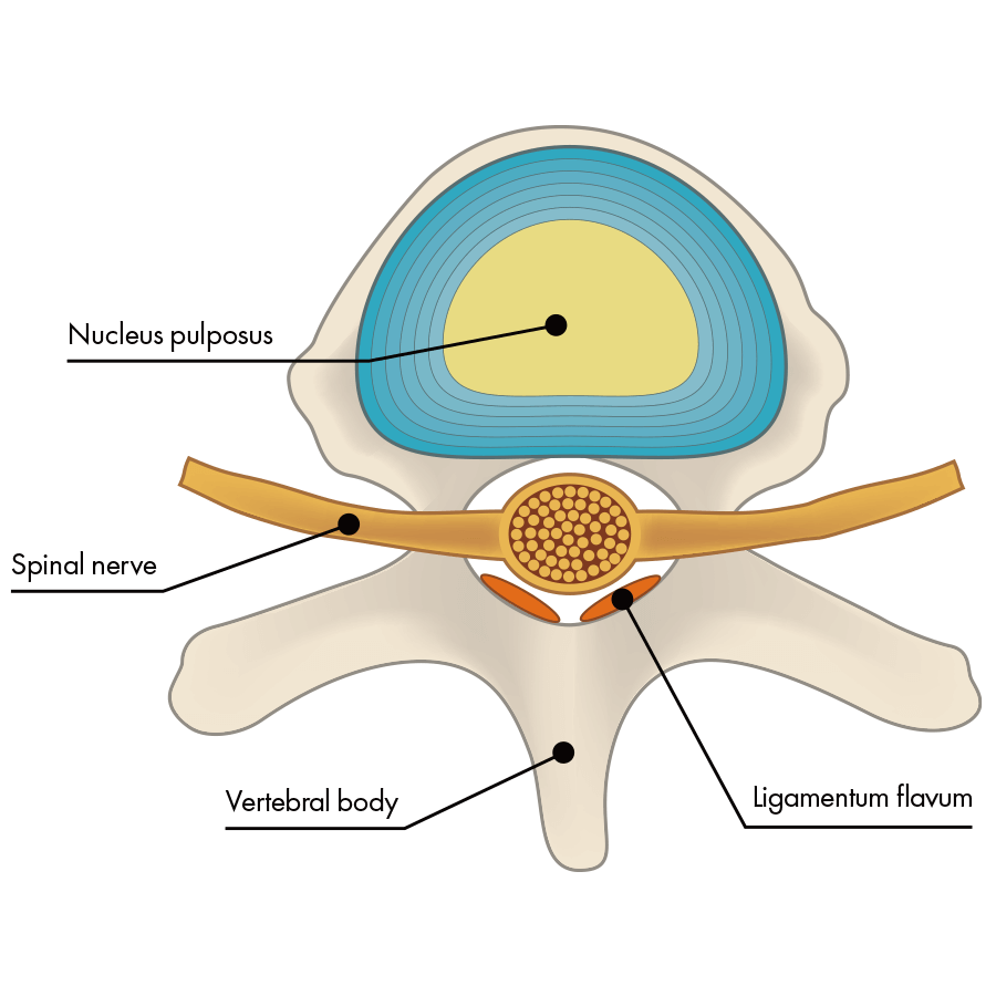 Normal intervertebral disc(Top)