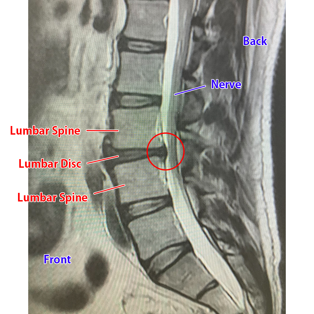 L3-L4 Treatment