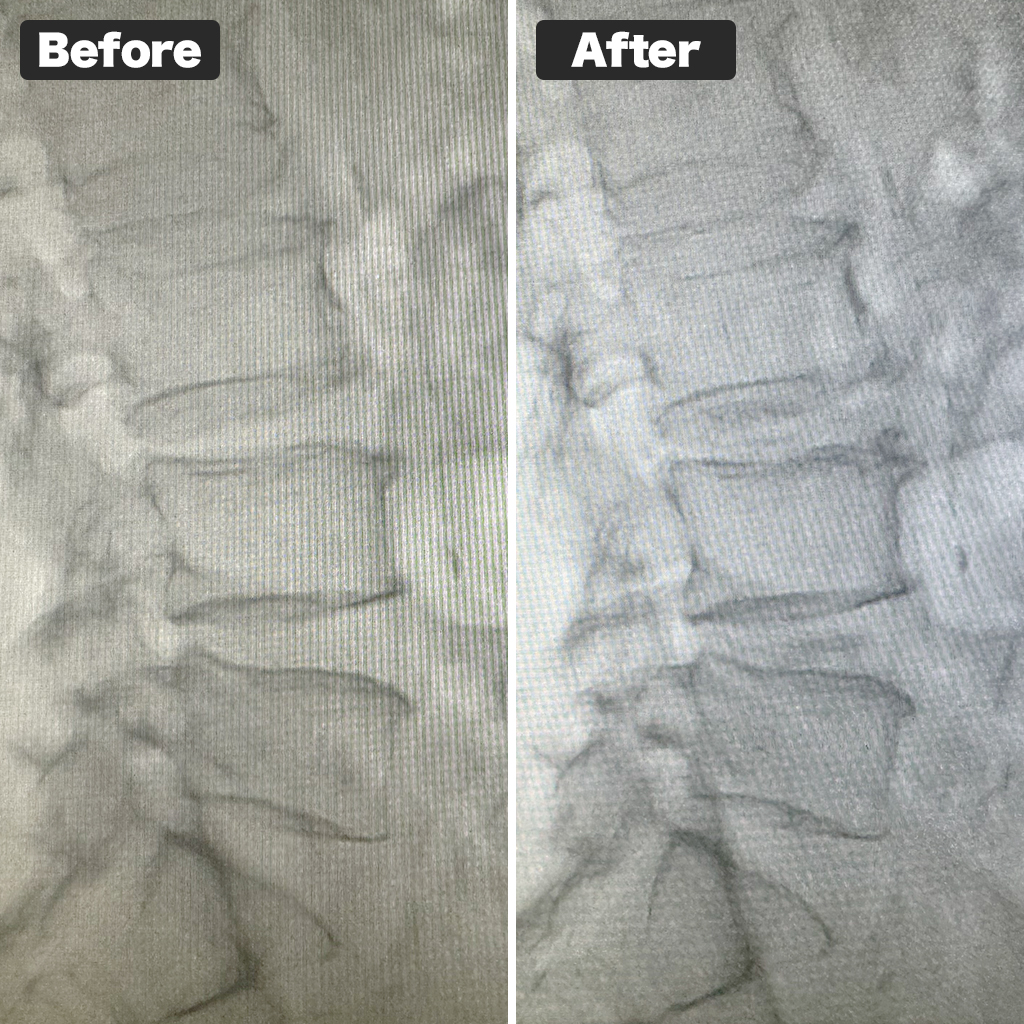 MRI Before and After Treatment