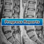 Seven Years After the Discseel Procedure