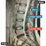 A patient in his 40s undergoing PLDD (Percutaneous Laser Disc Decompression) for Disc Herniation