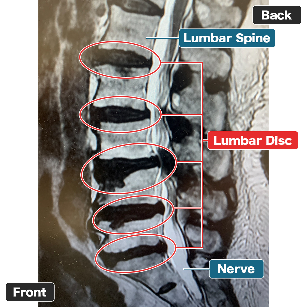 MRI