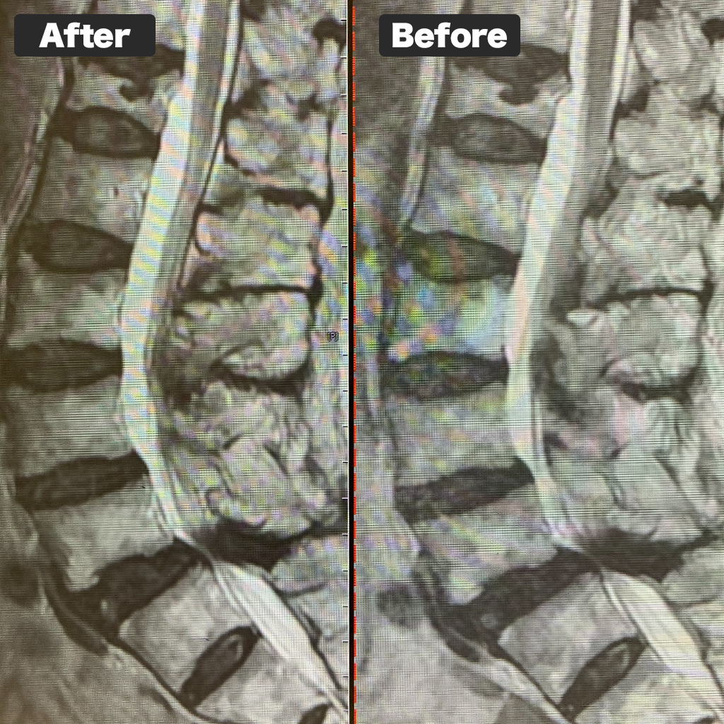 MRI Before and After Treatment