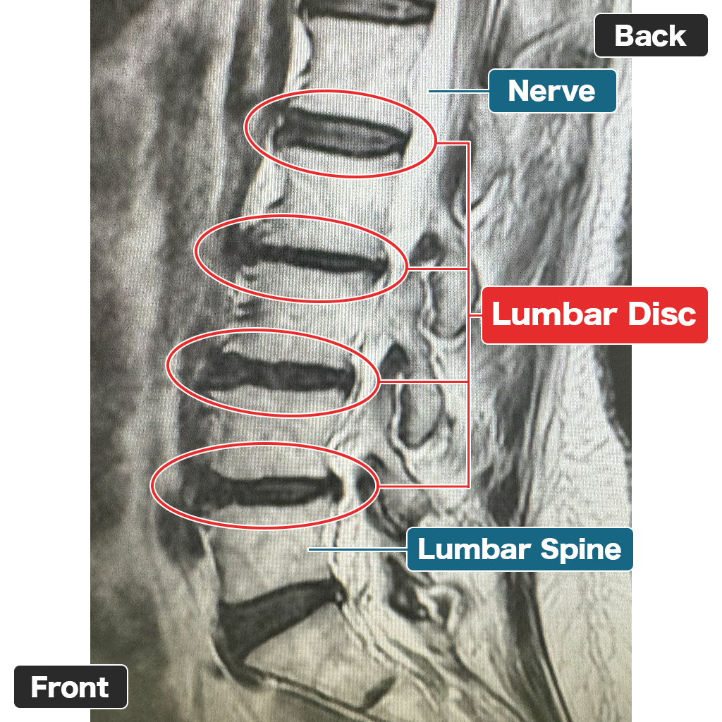 MRI