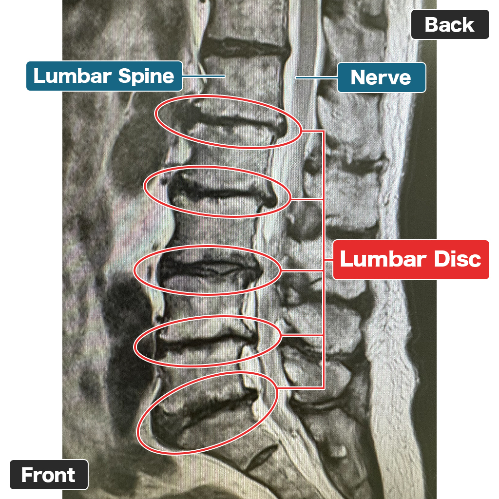 MRI