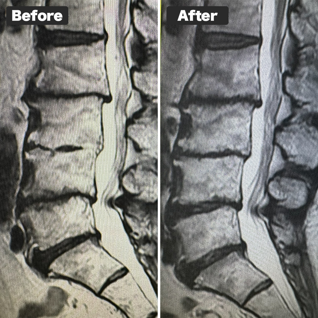 MRI Before and After Treatment