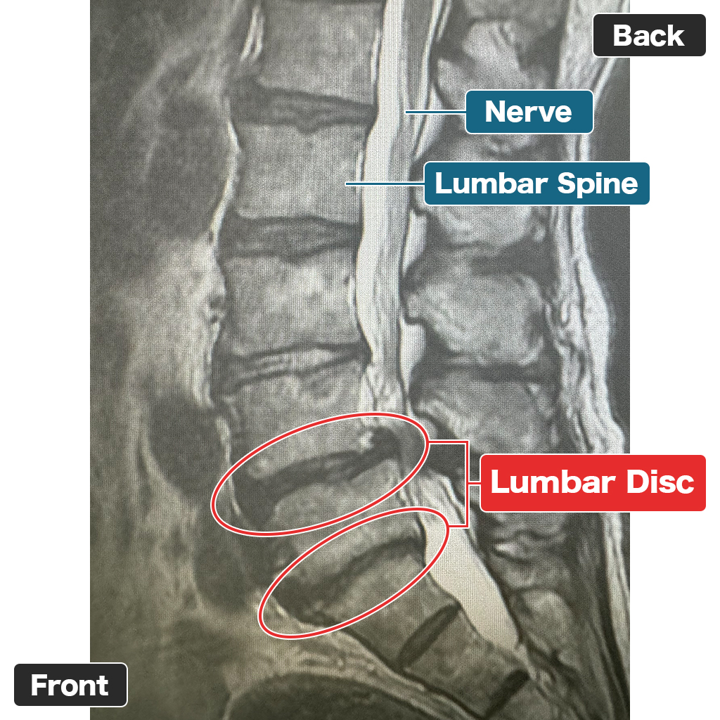 MRI