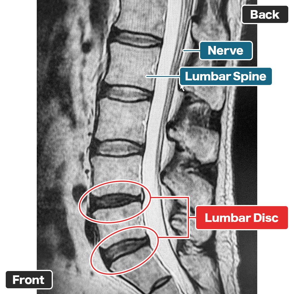 MRI