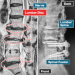 Treating a Friend's Father with Failed Fusion (Male, 70s)