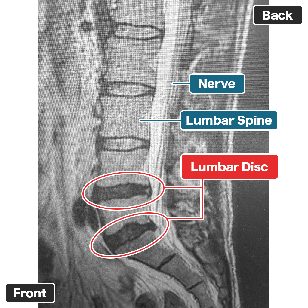 MRI
