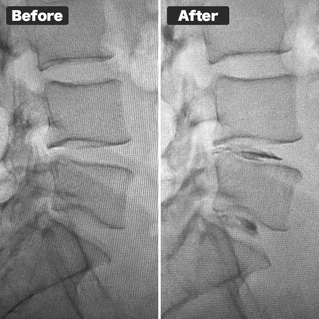 X-ray Before and After Treatment