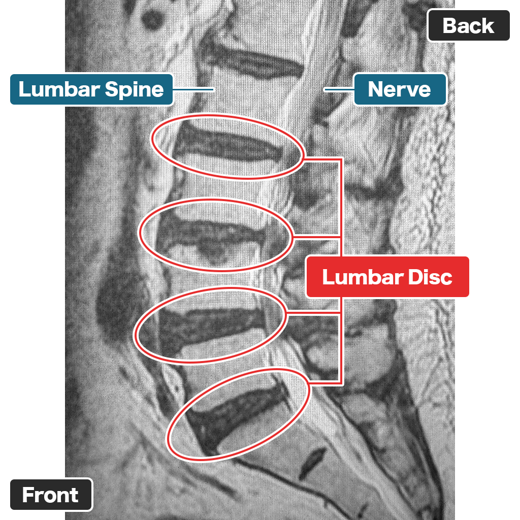 MRI