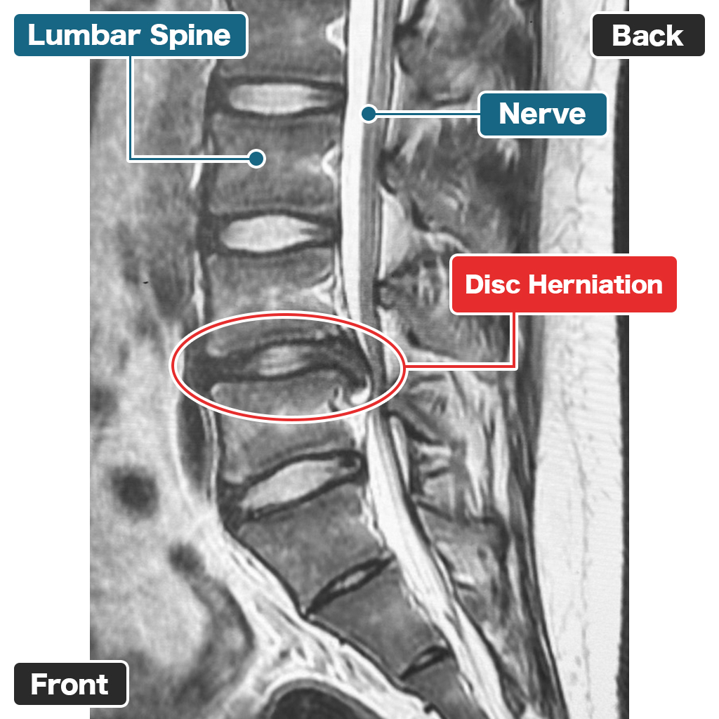 Pre-treatment MRI (Sagittal View)