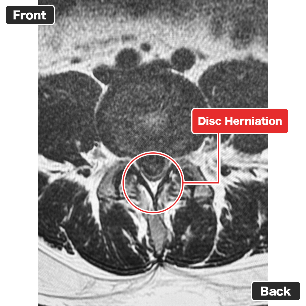 Pre-treatment MRI (Axial View)