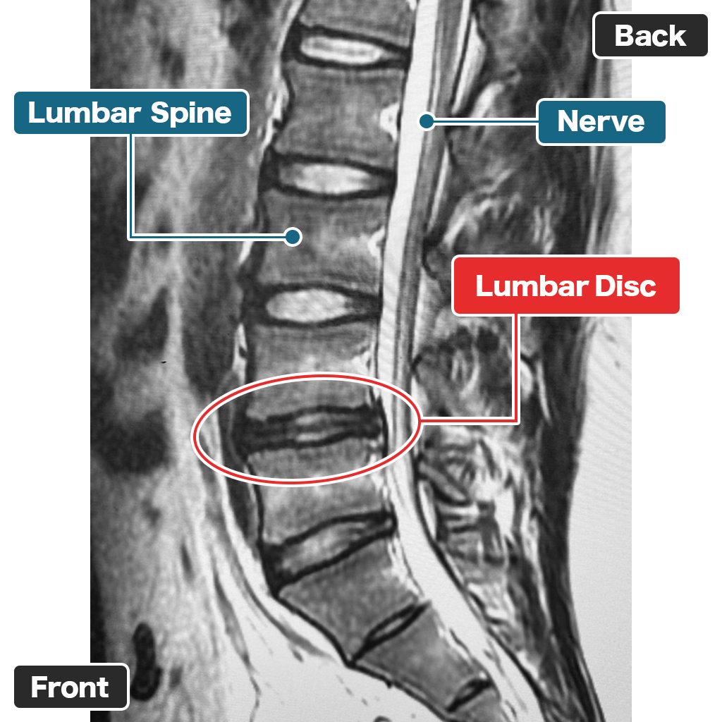 Post-treatment MRI (Sagittal View)