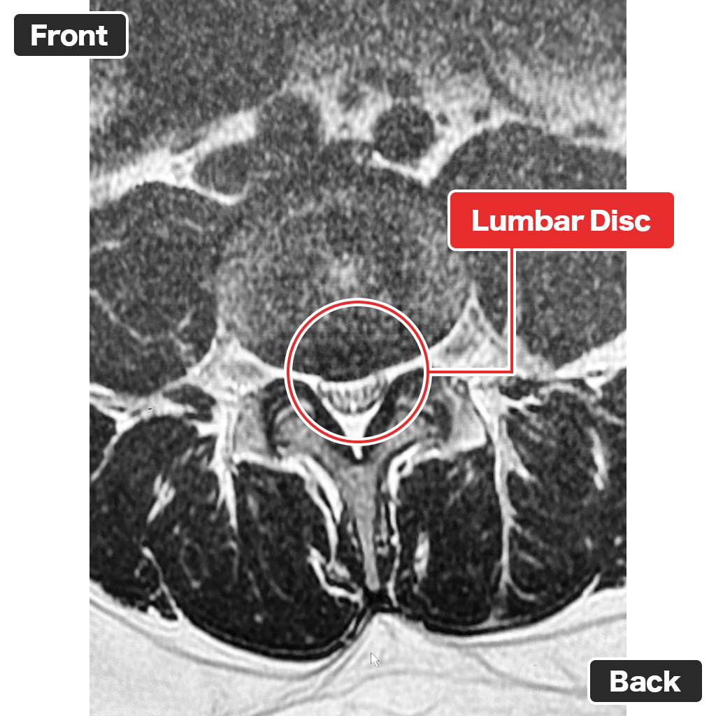 Post-treatment MRI (Axial View)
