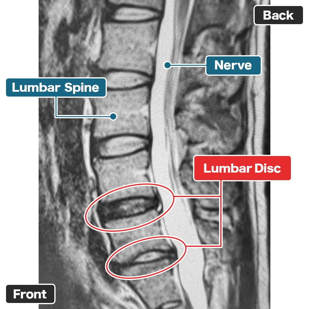 MRI Pinggang Sebelum Pengobatan