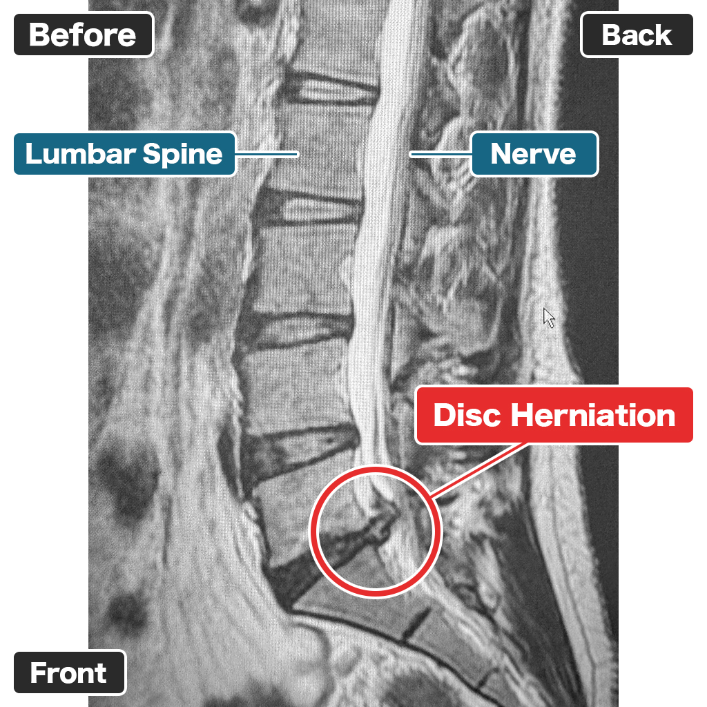 MRI: Before Treatment